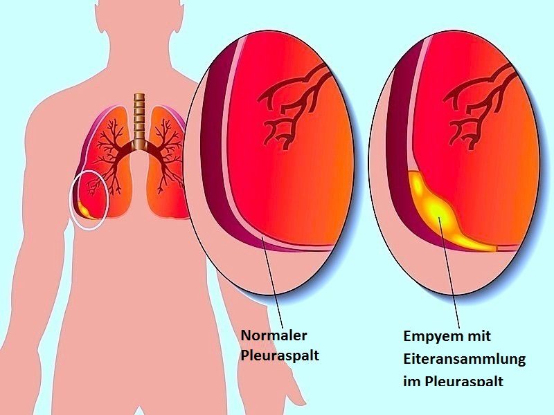 Empyema - Hình ảnh minh họa